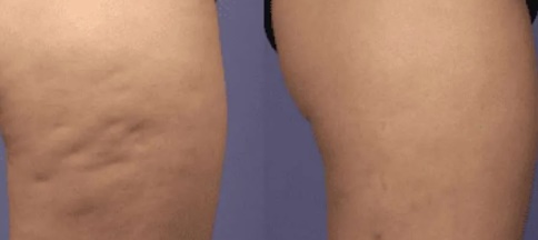 Thermage FLX neck body treatment Korea