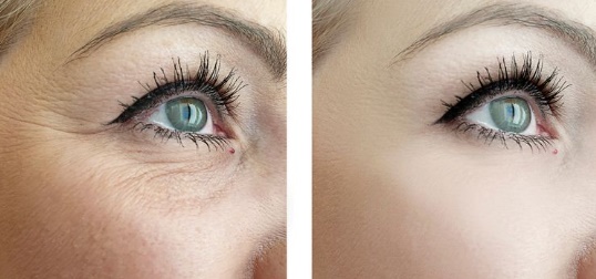 Thermage FLX eye treatment eyelids Seoul Korea